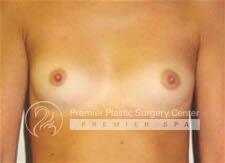 Breast Augmentation Before & After Image