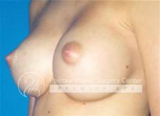 Breast Augmentation Before & After Image