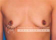 Breast Augmentation Before & After Image