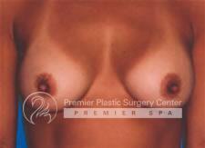 Breast Augmentation Before & After Image