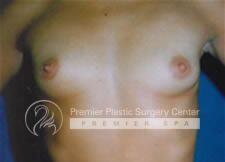 Breast Augmentation Before & After Image