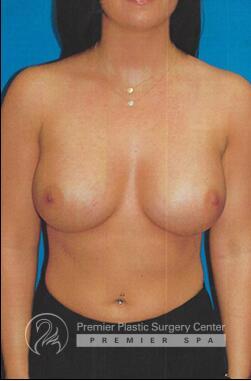 Breast Augmentation Before & After Image