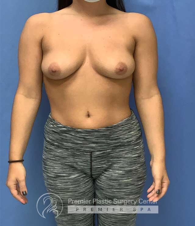 Breast Augmentation Before & After Image