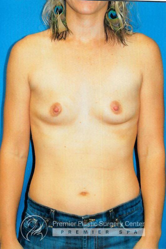 Breast Augmentation Before & After Image