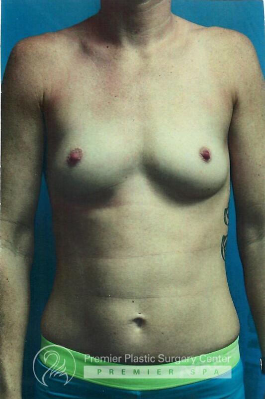 Breast Augmentation Before & After Image