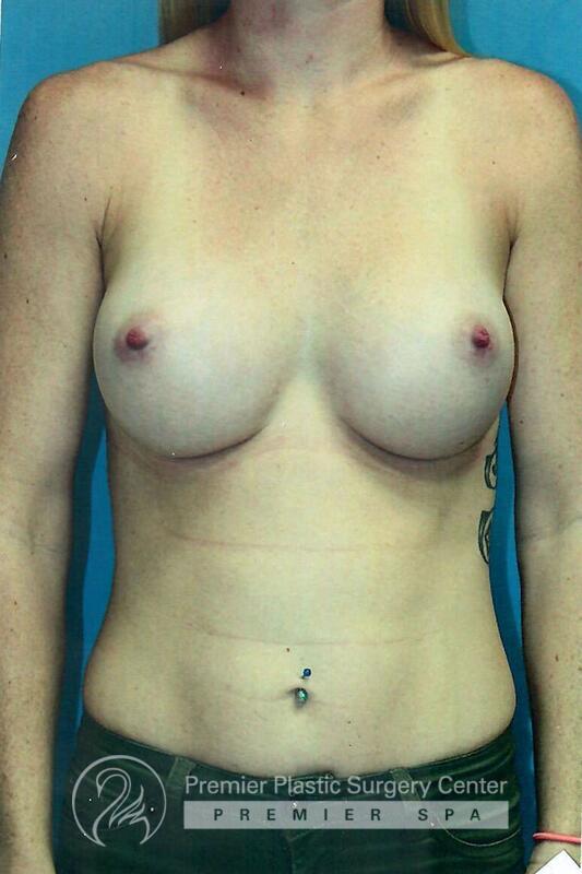 Breast Augmentation Before & After Image