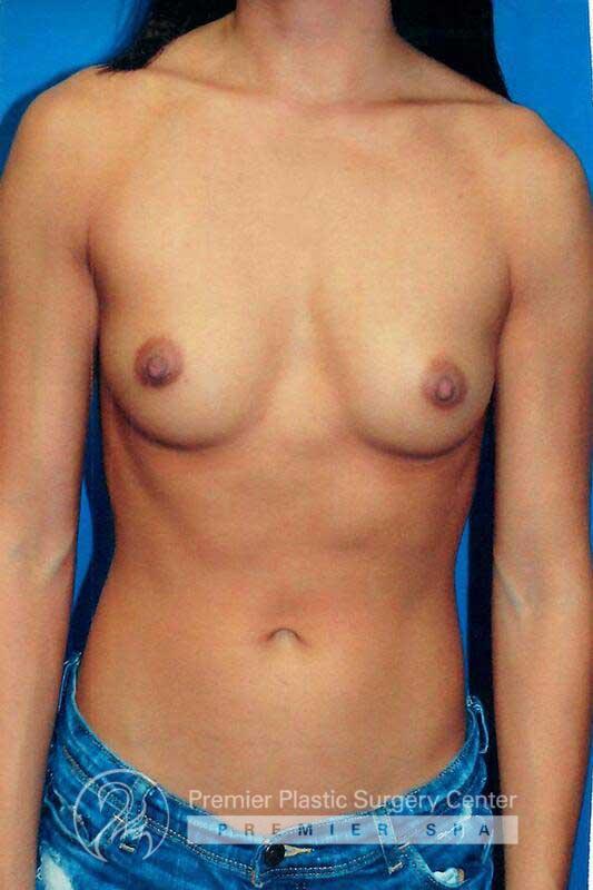 Breast Augmentation Before & After Image