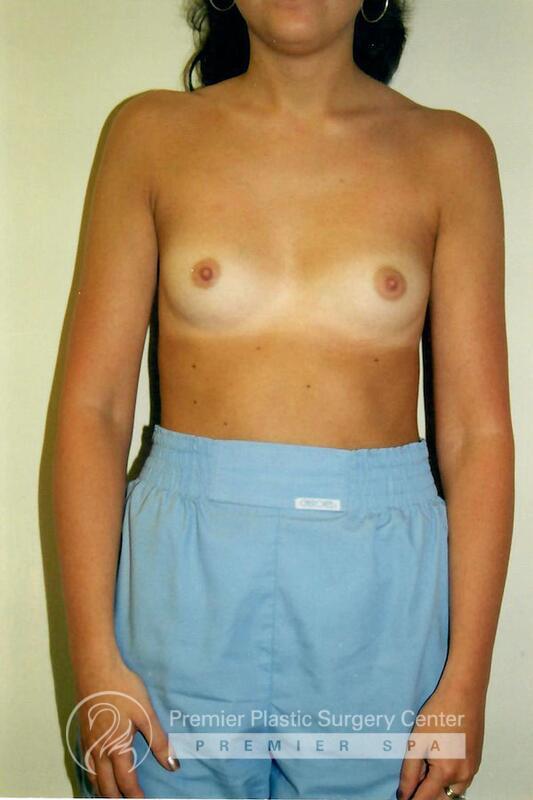 Breast Augmentation Before & After Image