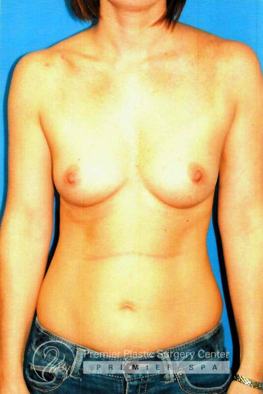 Breast Augmentation Before & After Image