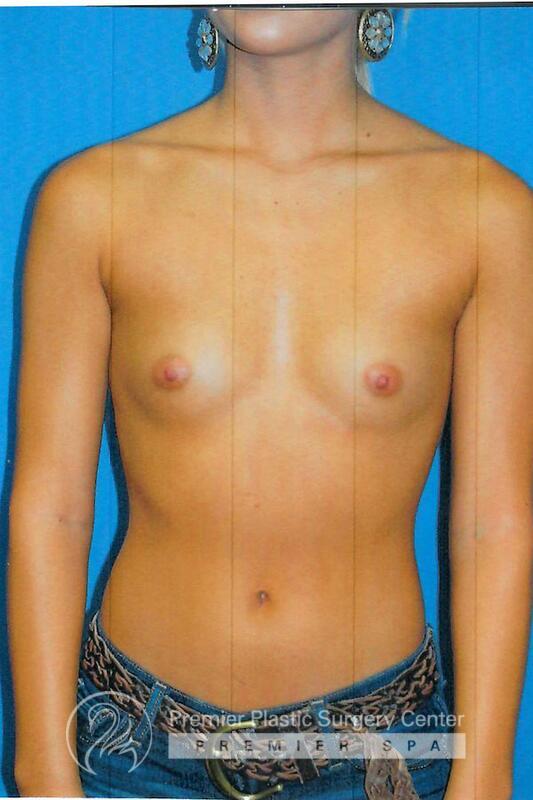 Breast Augmentation Before & After Image