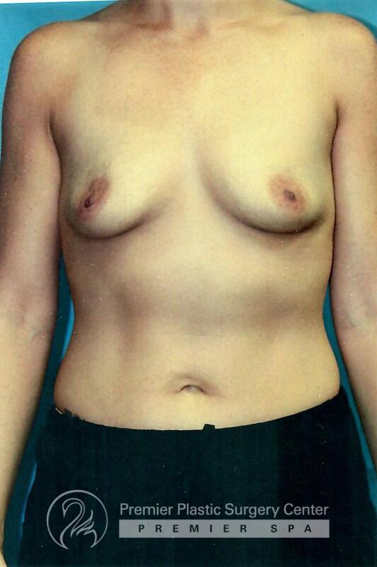 Breast Augmentation Before & After Image