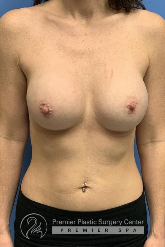 Breast Augmentation Before & After Image