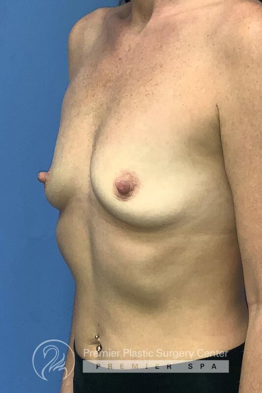 Breast Augmentation Before & After Image