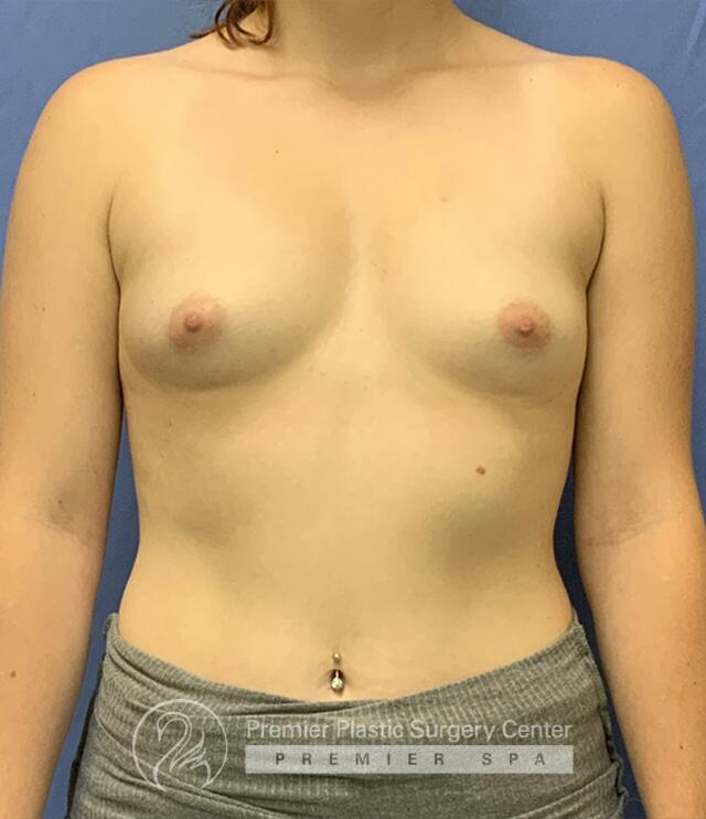 Breast Augmentation Before & After Image
