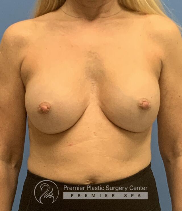 Breast Augmentation Before & After Image