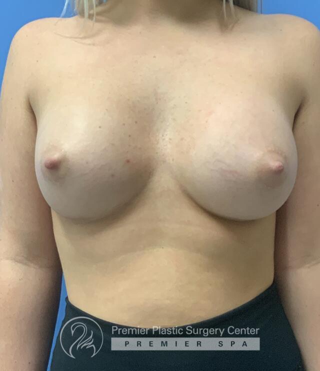 Breast Augmentation Before & After Image