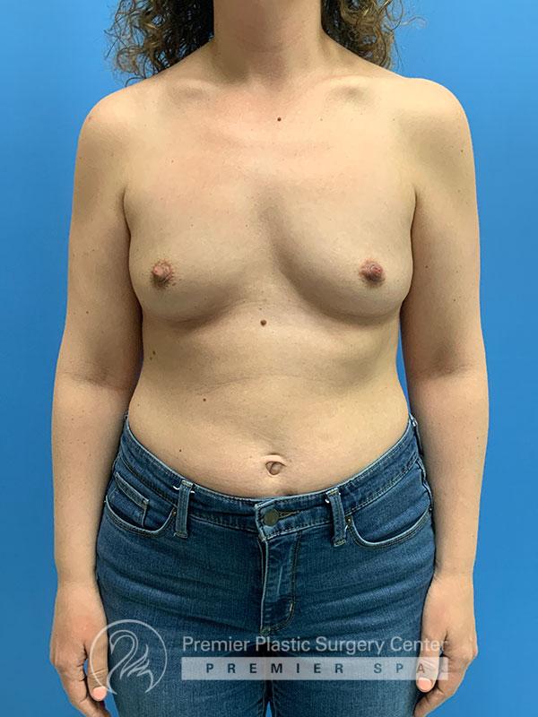 Breast Augmentation Before & After Image