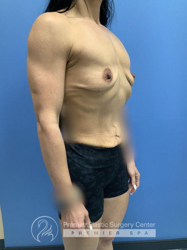 Breast Augmentation Before & After Image