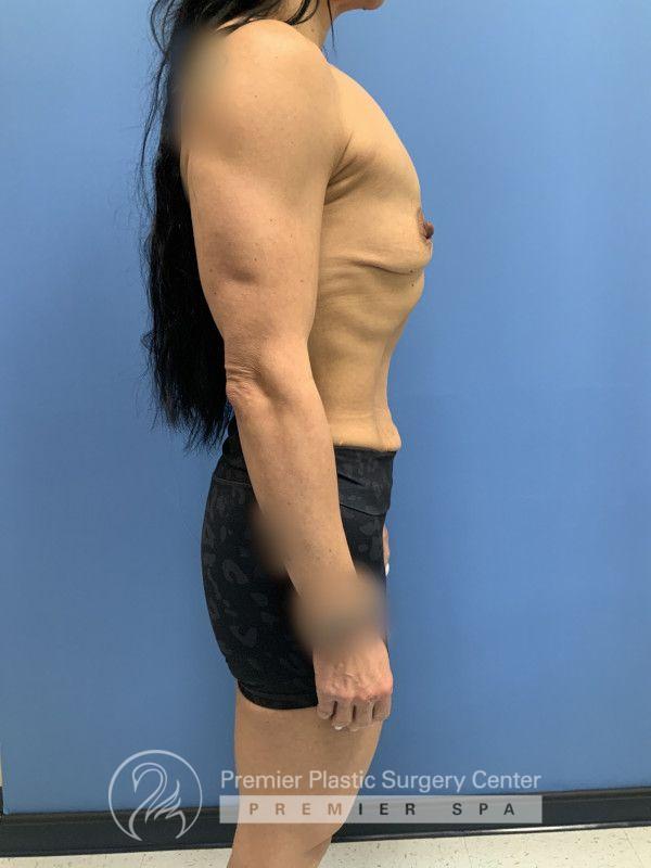 Breast Augmentation Before & After Image