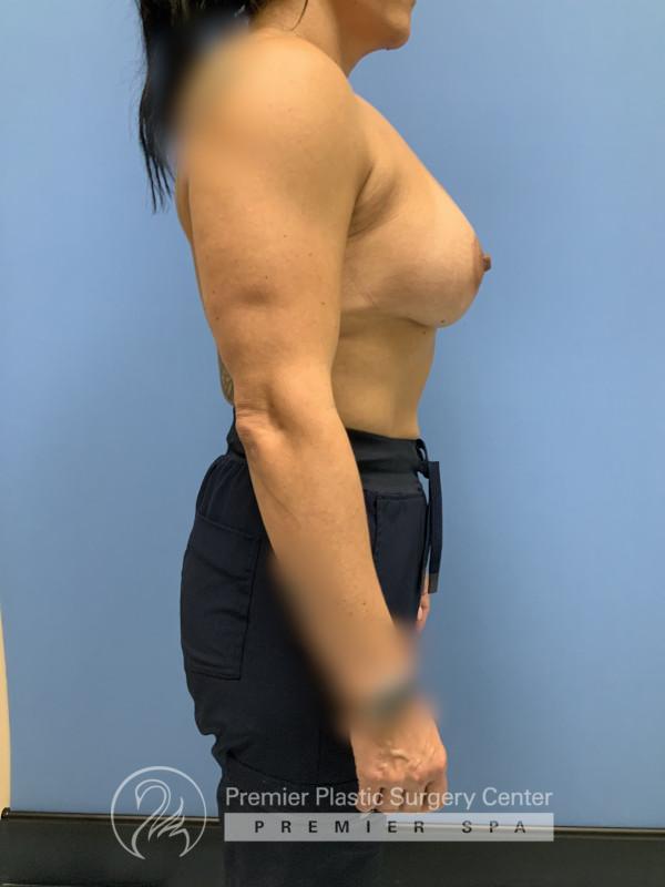 Breast Augmentation Before & After Image