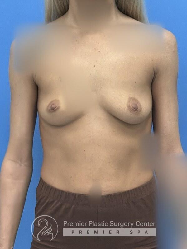 Breast Augmentation Before & After Image