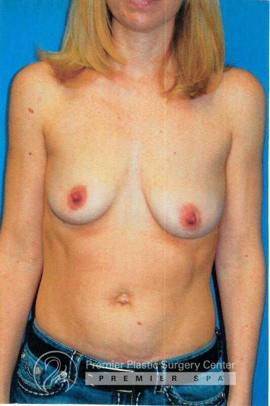 Breast Augmentation With Lift Before & After Image