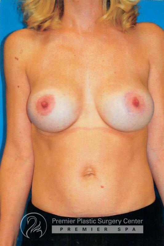 Breast Augmentation With Lift Before & After Image