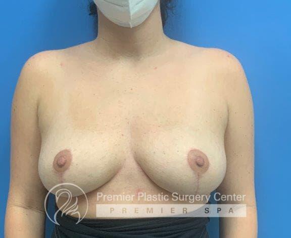 Breast Implant Removal Before & After Image