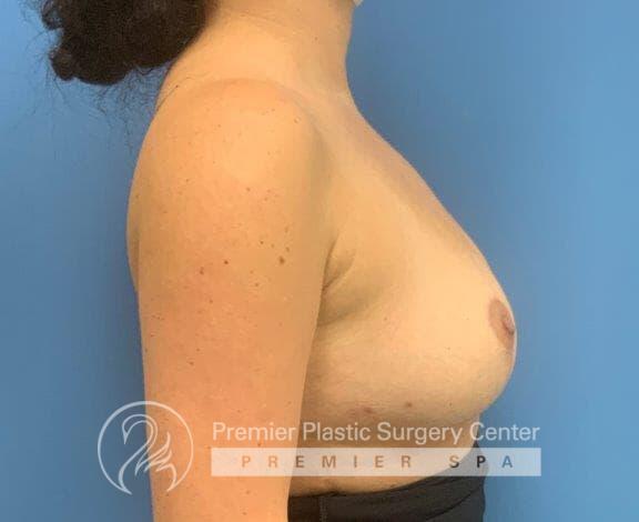 Breast Implant Removal Before & After Image