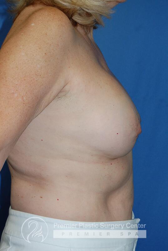 Breast Implant Removal Before & After Image
