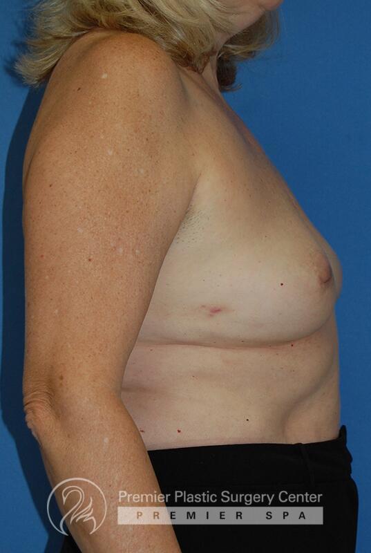 Breast Implant Removal Before & After Image