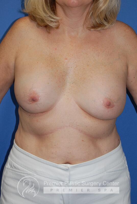 Breast Implant Removal Before & After Image