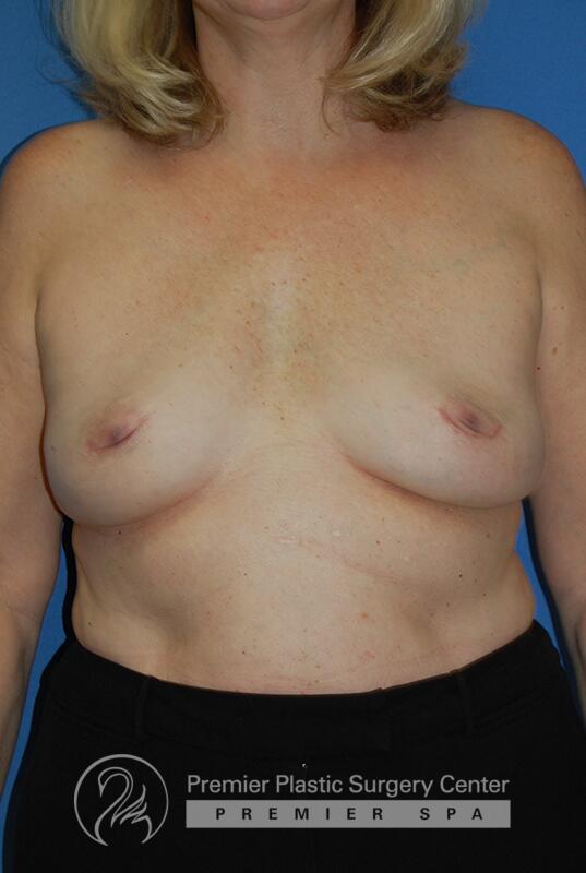 Breast Implant Removal Before & After Image