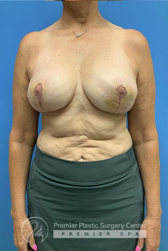 Breast Implant Removal Before & After Image