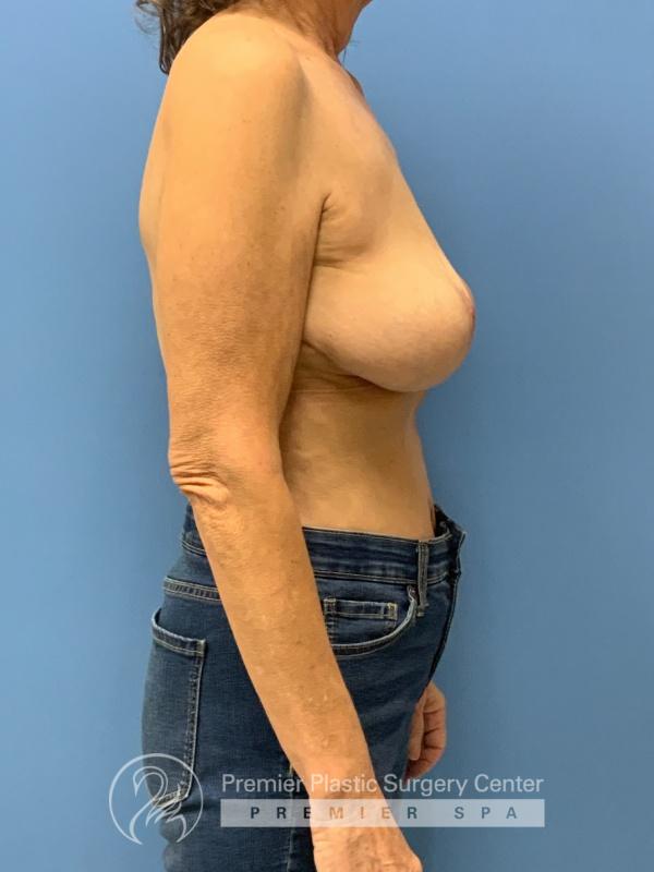 Breast Implant Revision Before & After Image