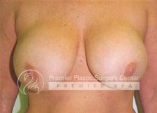Breast Lift Before & After Image