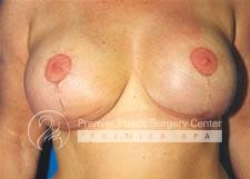Breast Lift Before & After Image