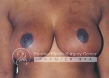 Breast Lift Before & After Image
