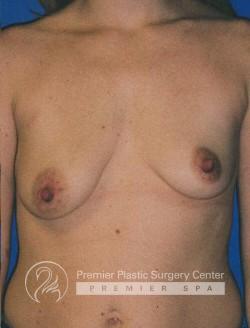 Breast Lift Before & After Image