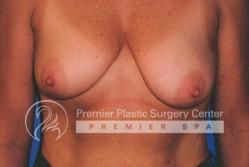 Breast Lift Before & After Image