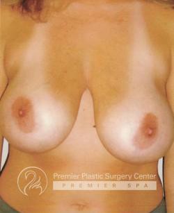 Breast Lift Before & After Image