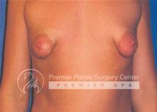 Breast Lift Before & After Image