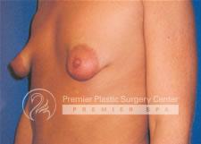 Breast Lift Before & After Image