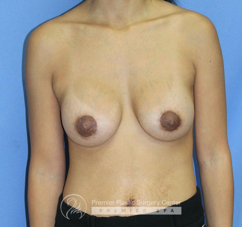 Breast Lift Before & After Image