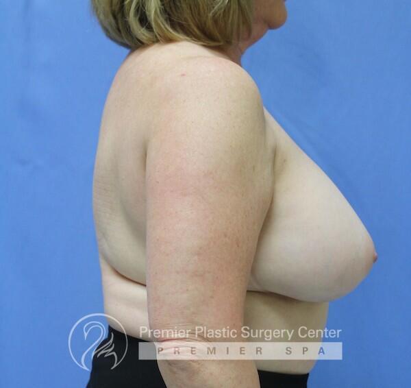 Breast Reduction Before & After Image