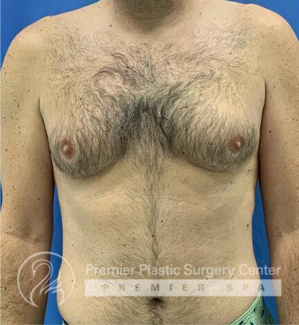 Gynecomastia Before & After Image