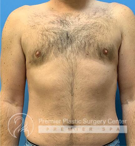 Gynecomastia Before & After Image