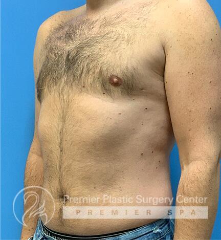 Gynecomastia Before & After Image