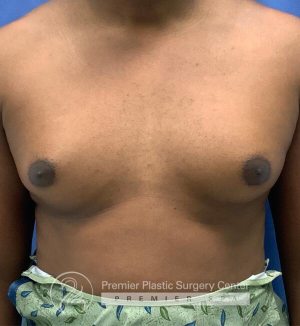 Gynecomastia Before & After Image
