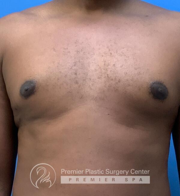 Gynecomastia Before & After Image